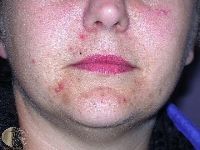 Fotoet viser akne excorié
