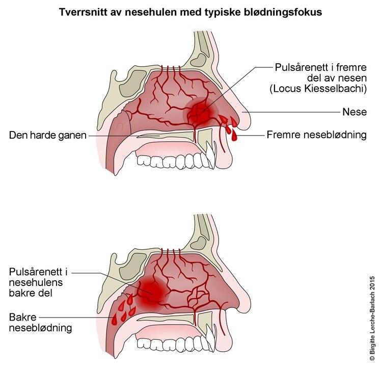 Neseblødning, fremre og bakre