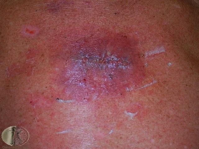 Fotoet viser en sårinfeksjon etter kirurgi i huden