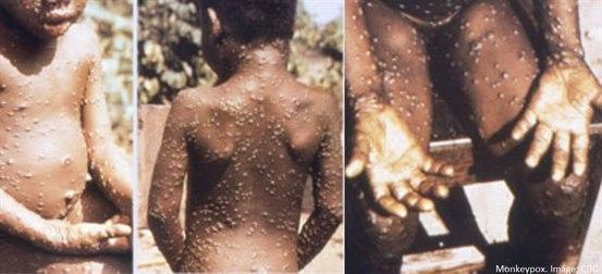 Monkeypox