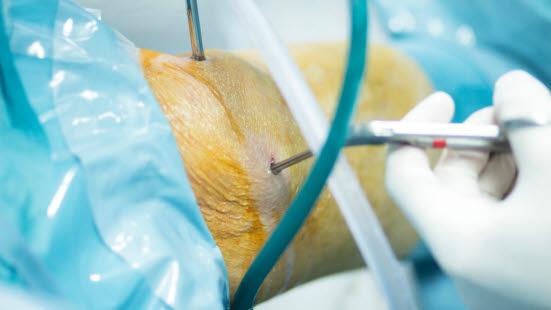 Artroskopi av kneleddet