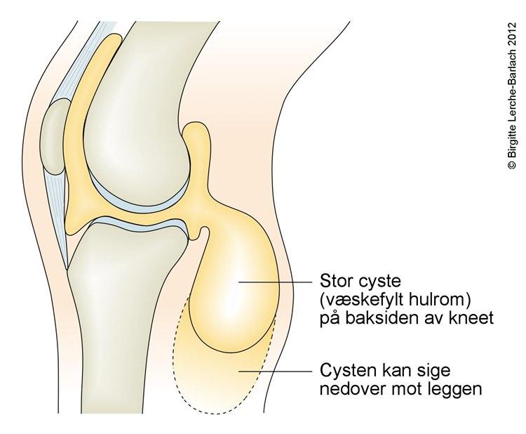 Kne med Bakers cyste
