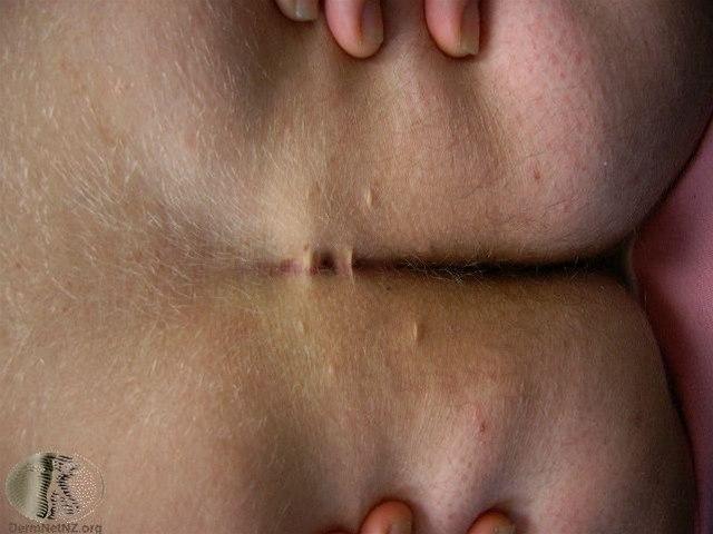 Fotoet viser pilonidalsykdom