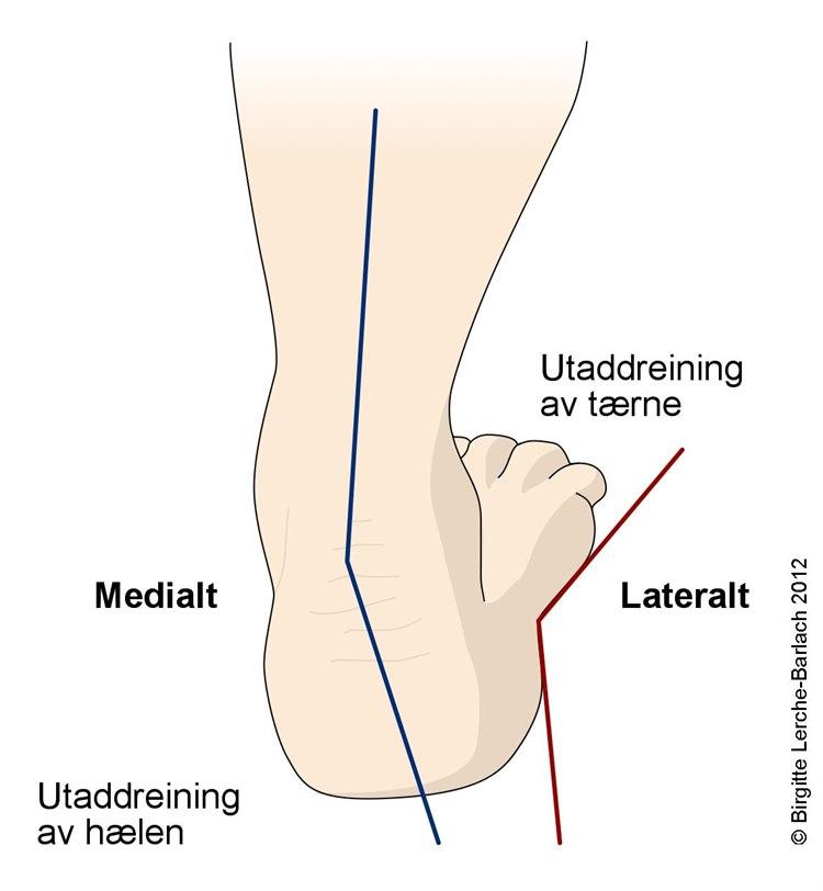 Ervervet plattfot, hælen sett bakfra