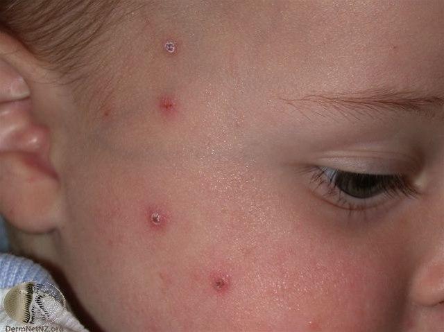 Fotoet viser vannkopper i ansiktet på en baby