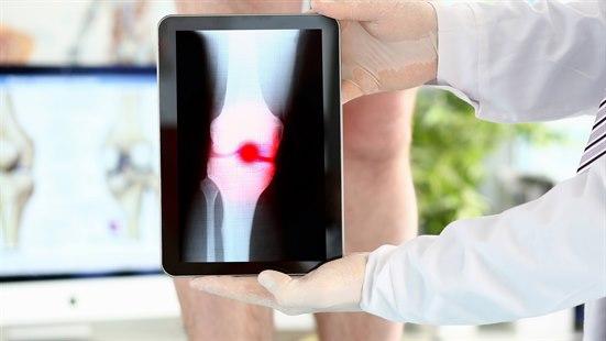 Bildet viser en mannlig lege som holder opp et nettbrett som viser et nærbilde røntgen av et smertefullt område, i dette tilfelle høyre kne