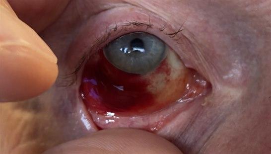 Subconjunctival bleeding