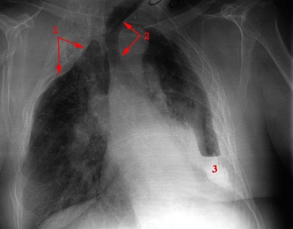 Tbc-torakoplastikk 2