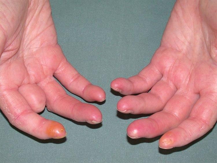 Fotoet viser nærbilde av håndflate og fingertupper med tegn til Sklerodaktyli