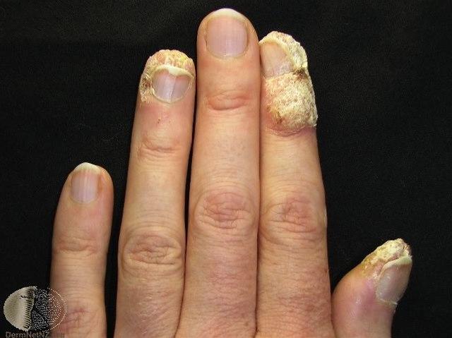 Fotoet viser nærbilde av fingrer med vorter, periunguale