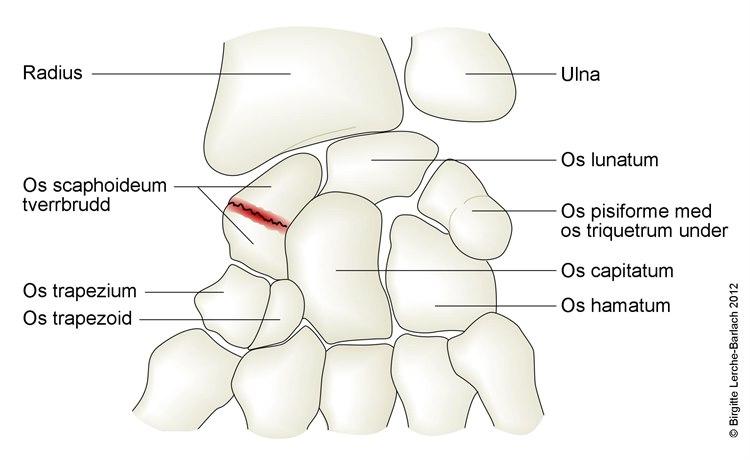 Brudd i båtbeinet, skafoidbeinet