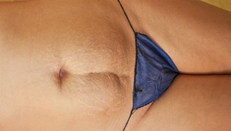 Delte magemuskler og strekkmerke-arr etter graviditet