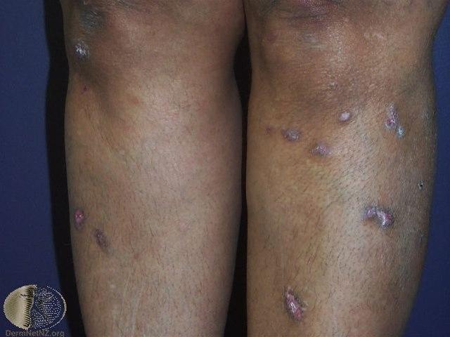 Fotoet viser lichen planus, hypertrofisk