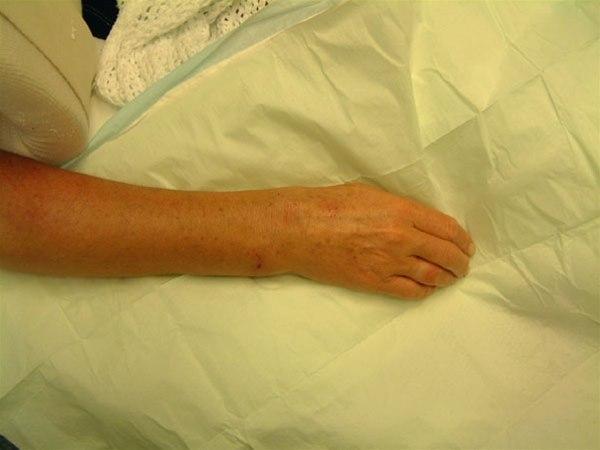 Radiusbrudd, feilstilling