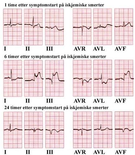 Infarkt - invertert T