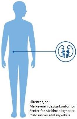 Blæreekstrofi og epispadi