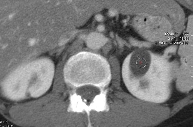 CT-bilde av nyrecyste