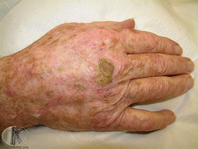 Fotoet viser aktinisk keratose, horn 