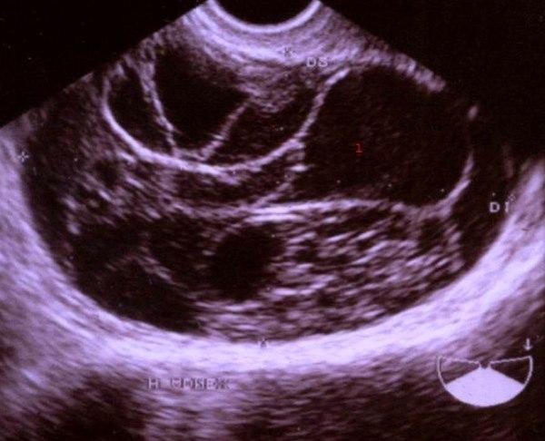 Mucinøst cystadenom (ultralydbilde)