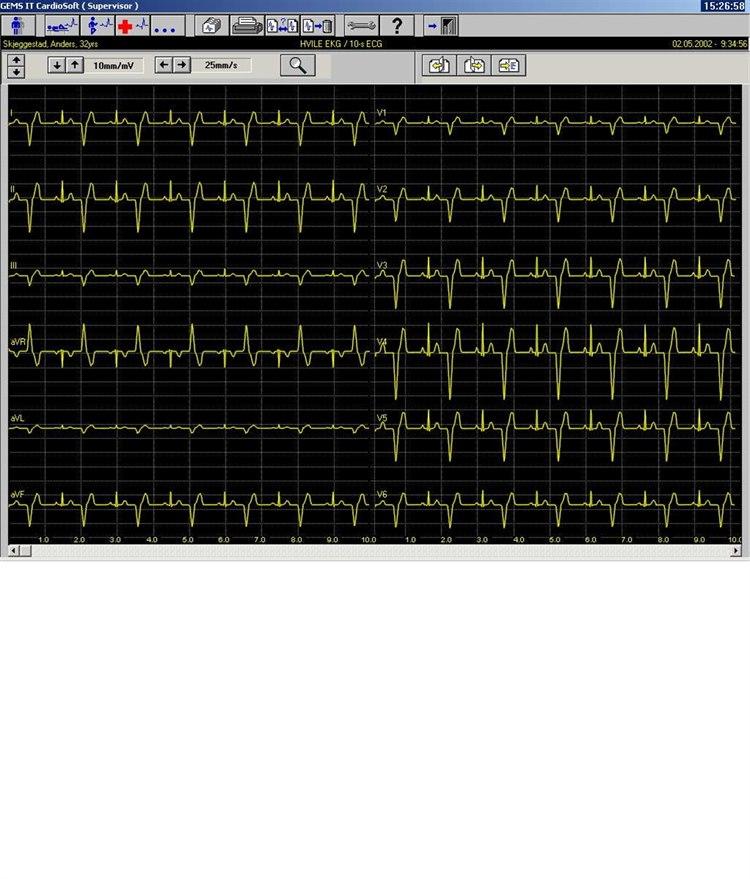 Ventrikulær bigemini