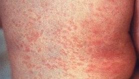 Rubella