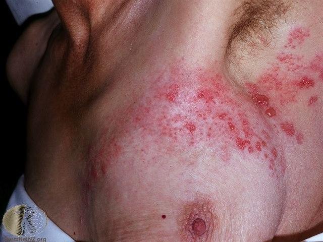 Fotoet viser herpes zoster, torakal