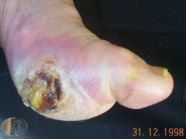 Fotoet viser nærbilde av siden på en fot med med sårinfeksjon