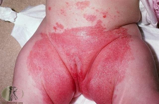 Fotoet viser bleiedermatitt, uttalt