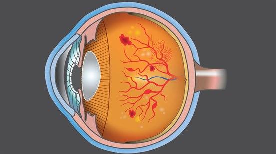 Retinopati