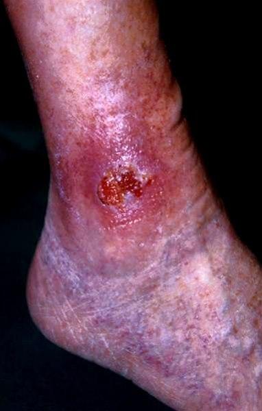 Viktig differensialdiagnose til venøst leggsår som ikke svarer på optimal behandling. Ta biopsi!