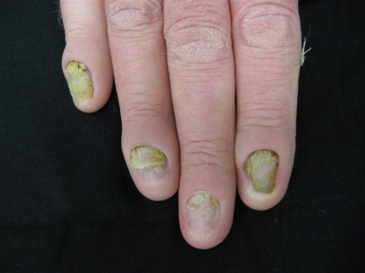 Fotoet viser nærbilde av fingertupper med negler som viser tegn til gul negl syndrom