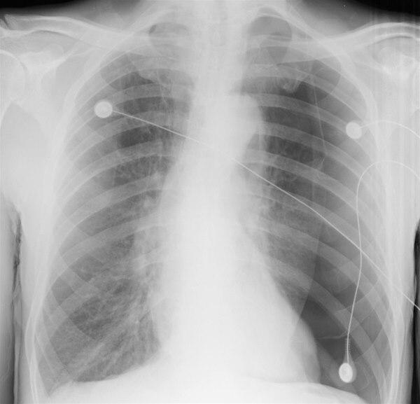 pneumothorax, spontan