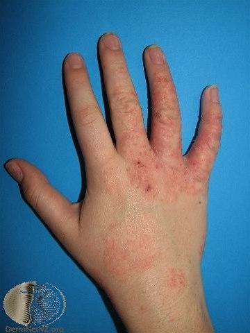 Fotoet viser atopisk eksem, barn hånd