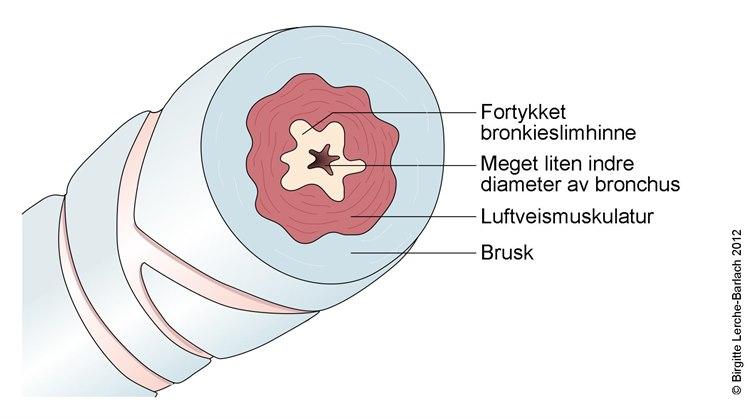 Bronkie ved astma