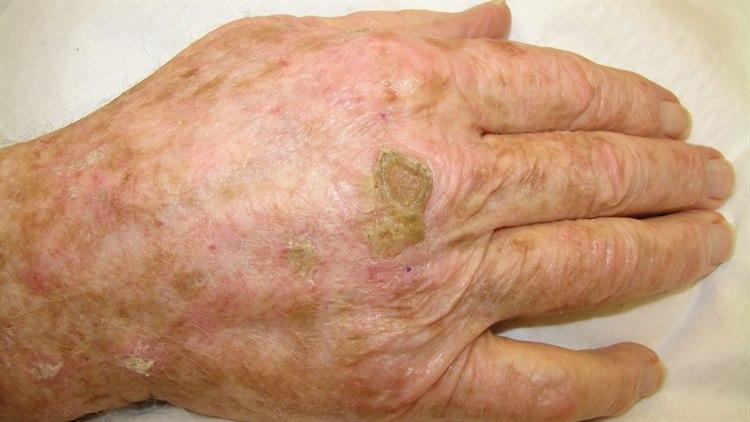 Aktinisk keratose, horn