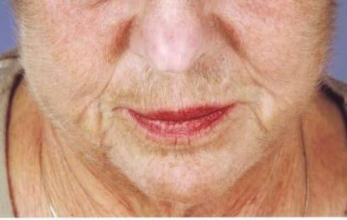 Porphyria cutanea tarda face