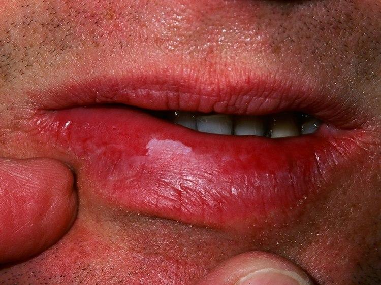 Skyldes som regel en irritant i munnhulen, dårlig tilpasset gebiss, røyking eller snus. Ses også ved enkelte sykdommer, og kan utvikle seg malignt.