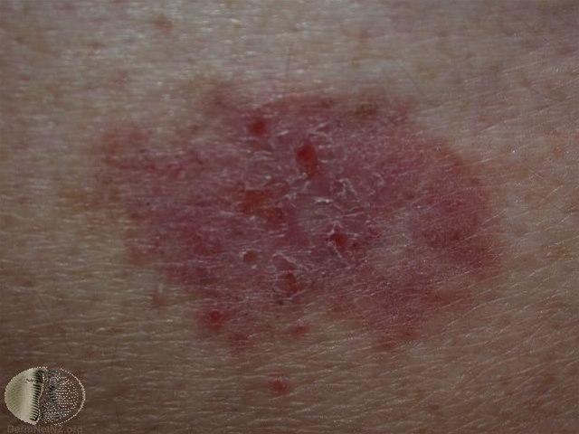 Fotoet viser basaliom, overflatisk