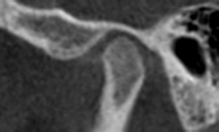 Friskt kjeveledd, jente 14 år. Foto:  Avdeling for kjeve- og ansiktsradiologi, UiO/OD