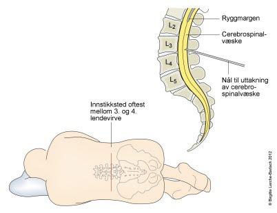 Lumbalpunksjon