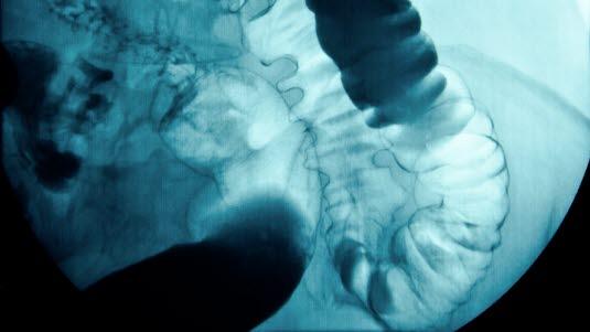 Røntgen av tykktarmen