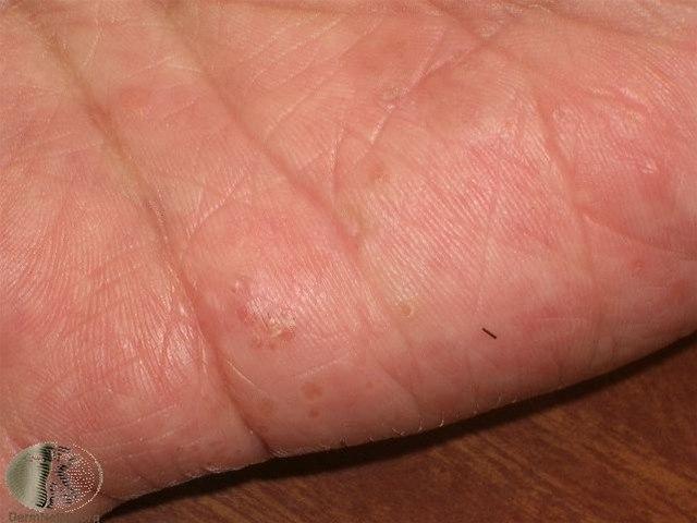 Fotoet viser vesikkel