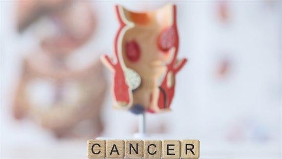 Illustrasjon av kreftsvulster i endetarmen.