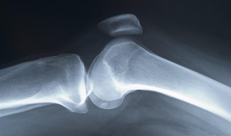 Lårbeinet og leggbeinet