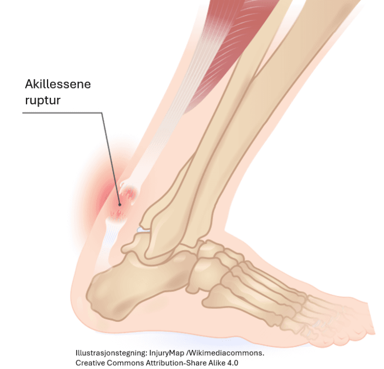 Illustrasjonstegningen viser en avrevet akillessene