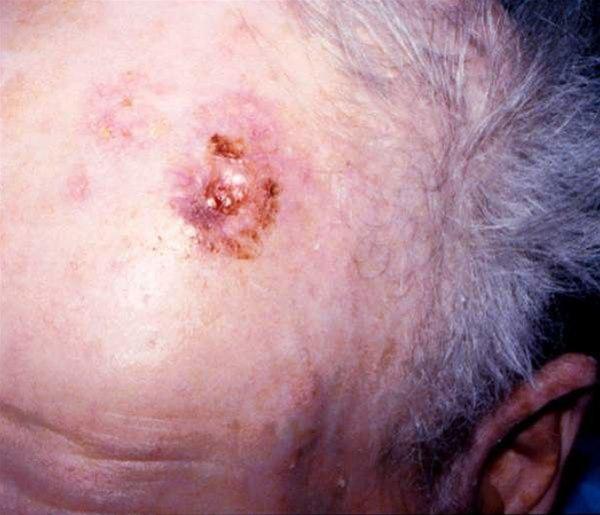 Solskadet hud med rasktvoksende, ulcererende tumor.