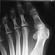 Hallux valgus