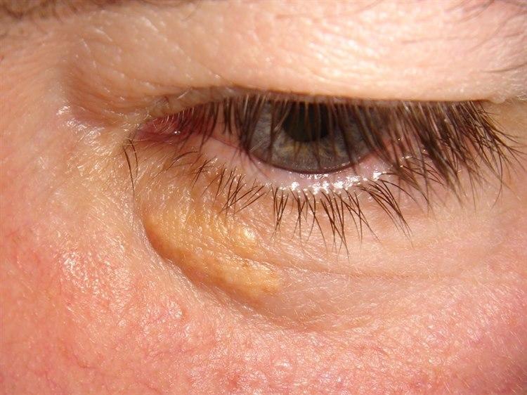 Fotoet viser nærbilde under øyet til en pasient med tegn til xanthelasme