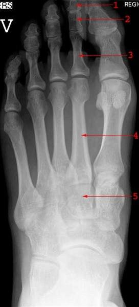 Røntgen av normal fot