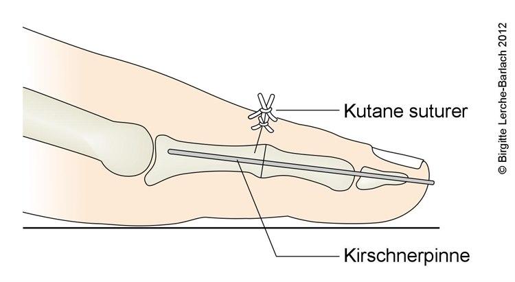 Hammertå etter operasjon